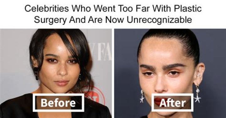 Ana Barbara Nose Plastic Surgery, Before and After Plastic Surgery Photos - SarkariResult